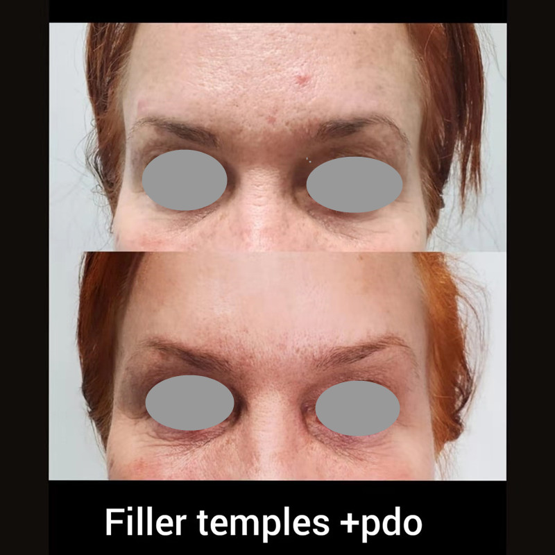 How to inject hyaluronic acid to make the forehead fuller?