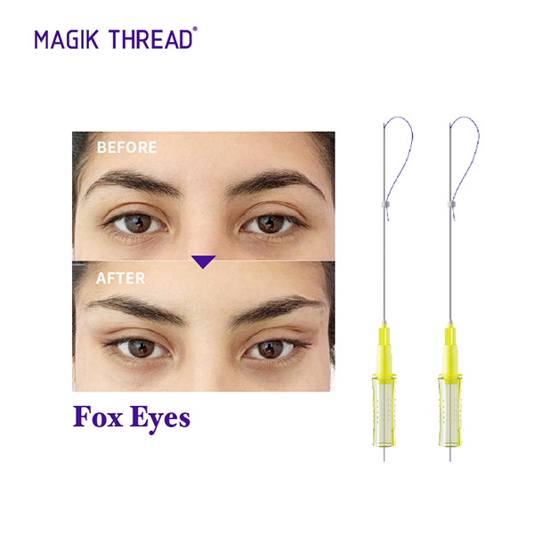 Pdo Threads for under Eye Wrinkles