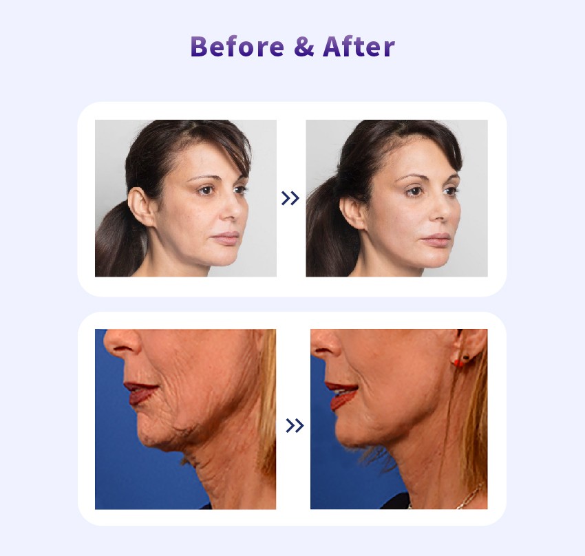 pdo thread lift jawline before and after Dermax