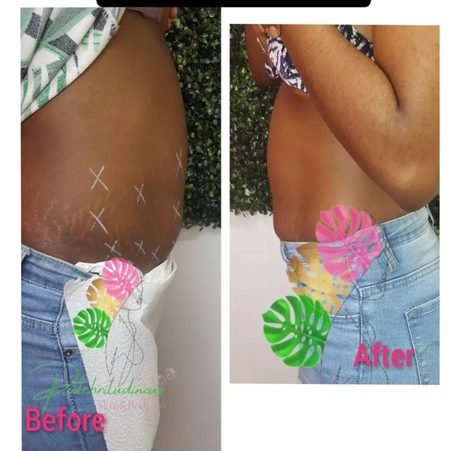 dermaxmed lipolab filler feedback