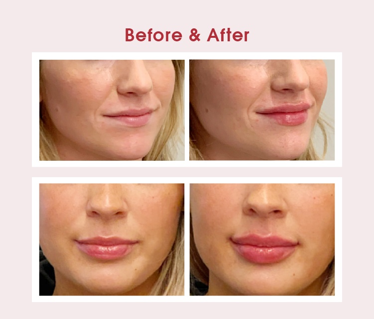 hyaluronic acid lip filler, Buy hyaluronic acid lip filler, hyaluronic