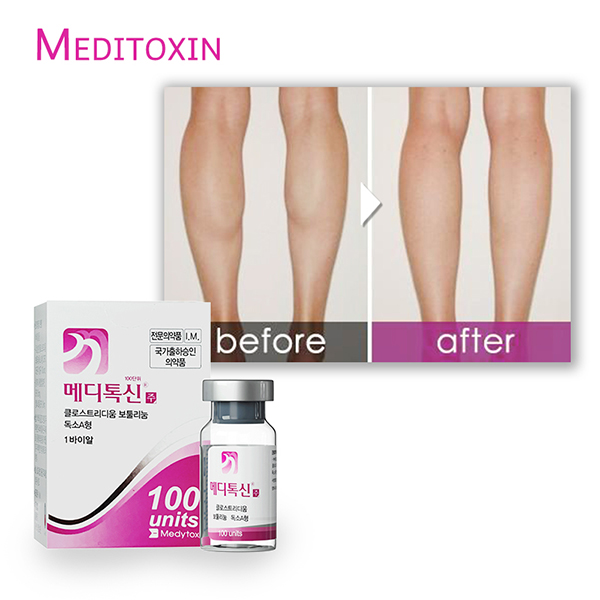 botulinum toxin 100 units