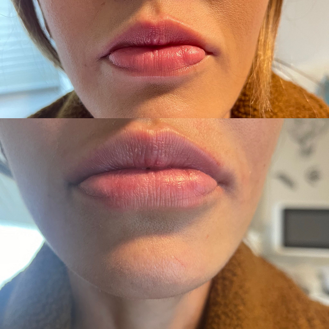 dermaxmed lip filler feedback